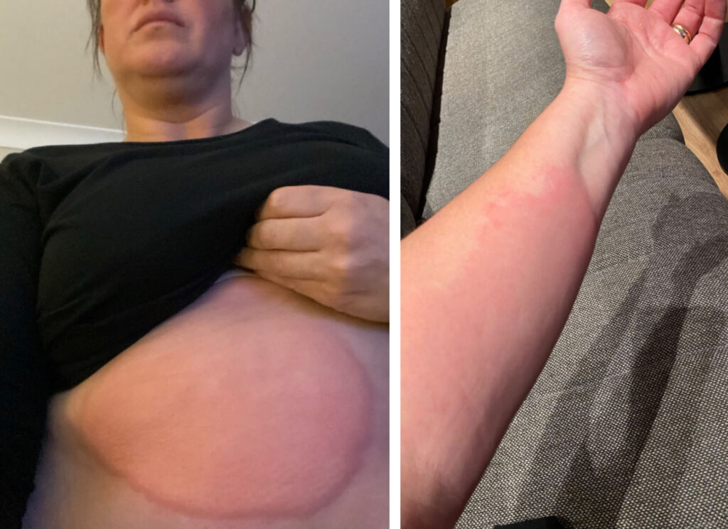 Danielle swelling